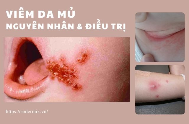 Viêm da mủ - Nguyên nhân và điều trị