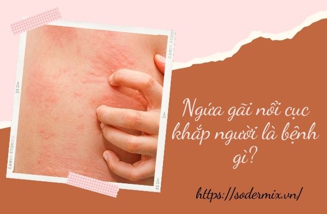 Bị ngứa gãi nổi cục khắp người là bệnh gì? Cách chữa như thế nào? 1