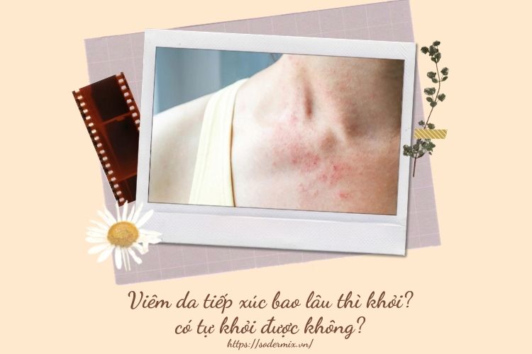 Viêm da tiếp xúc bao lâu thì khỏi? Có tự khỏi được không? 1