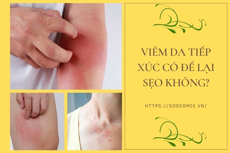 Viêm da tiếp xúc có để lại sẹo không? 1