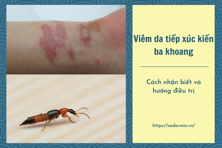 Viêm da tiếp xúc kiến ba khoang - Cách nhận biết và hướng điều trị 1