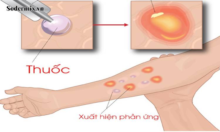 Các xét nghiệm cần làm để chẩn đoán 1