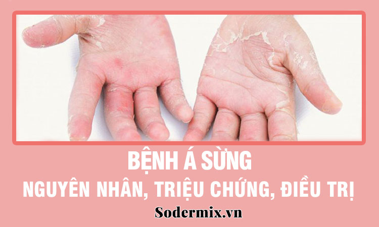 Bệnh á sừng: nguyên nhân, triệu chứng, cách điều trị! 1