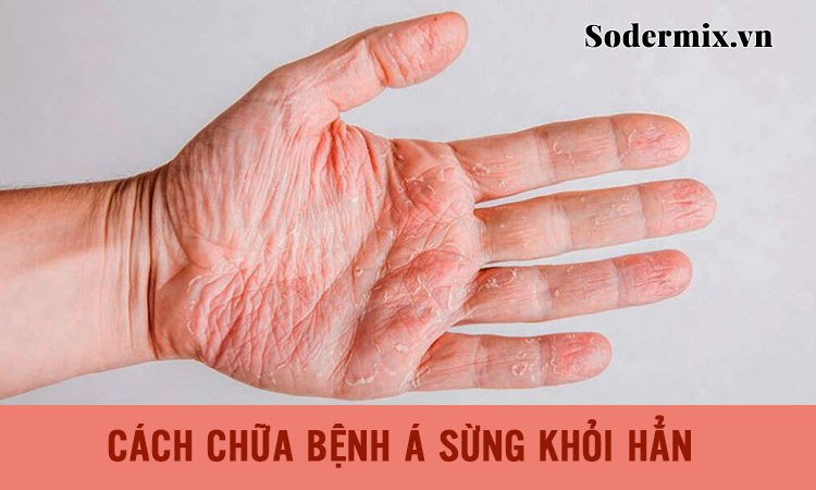 Cách chữa bệnh á sừng dứt điểm hiệu quả!