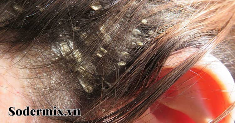 Chàm da đầu (Scalp eczema) 1