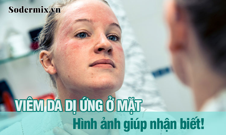 Hình ảnh viêm da dị ứng ở mặt giúp nhận biết chính xác!