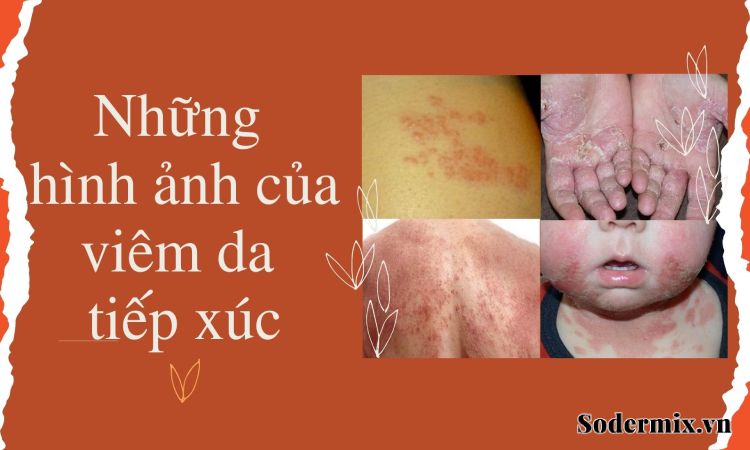 Phân tích hình ảnh viêm da tiếp xúc giúp bạn nhận biết bệnh!