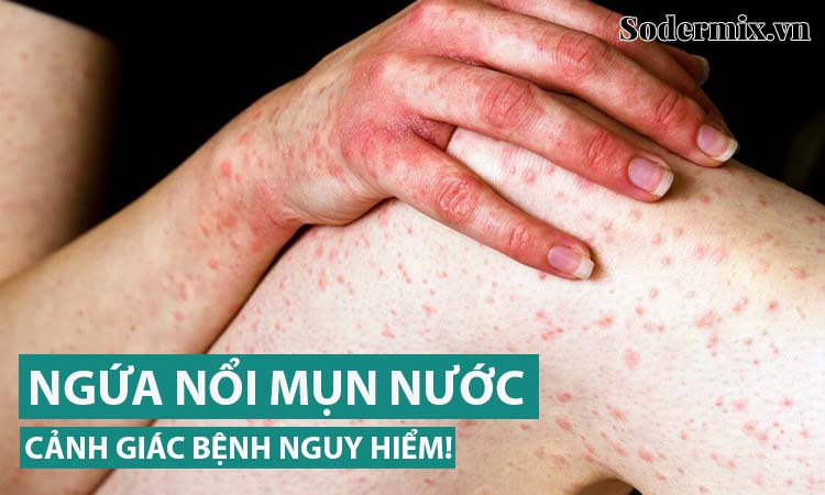 Ngứa nổi mụn nước ở tay chân - Lời nhắn từ bác sĩ da liễu!