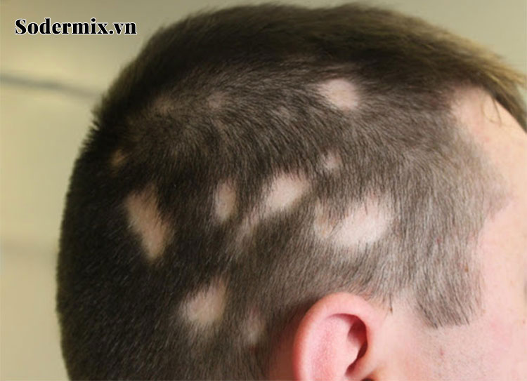 Rụng tóc từng mảng (Alopecia areata) 1