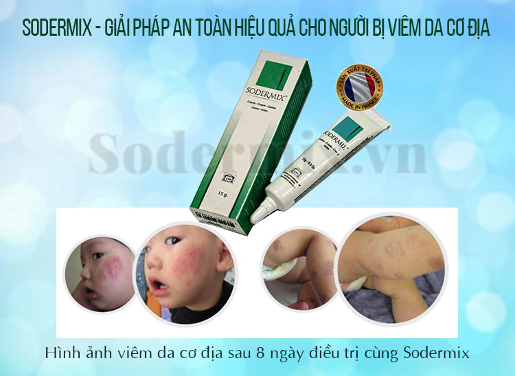 SODERMIX® - giải pháp an toàn, hiệu quả đẩy lùi viêm da cơ địa 1