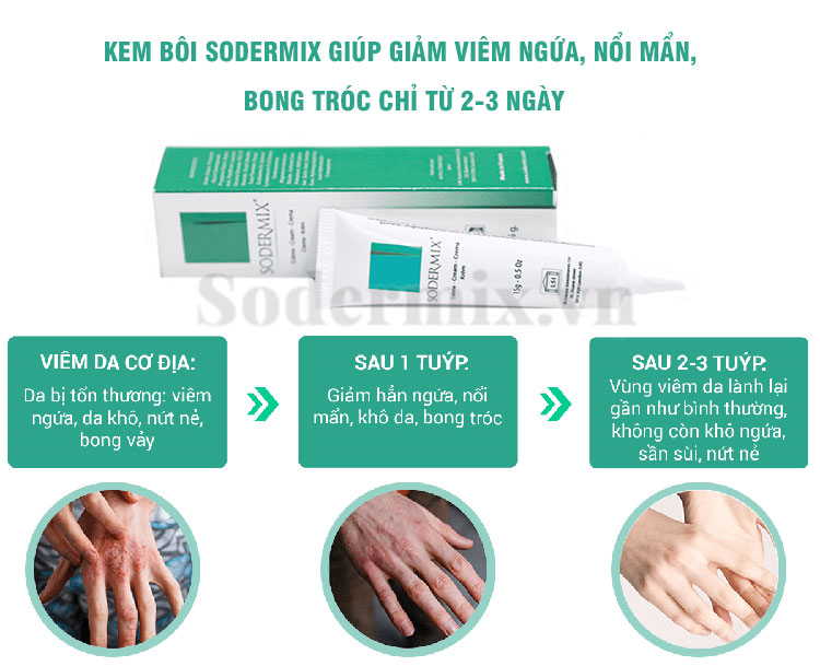 Kem bôi Sodermix - giải pháp hiệu quả cho người bệnh á sừng 1