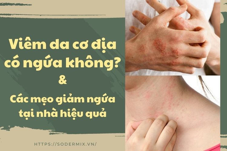 Viêm da cơ địa có ngứa không? Tổng hợp các mẹo giảm ngứa tại nhà hiệu quả