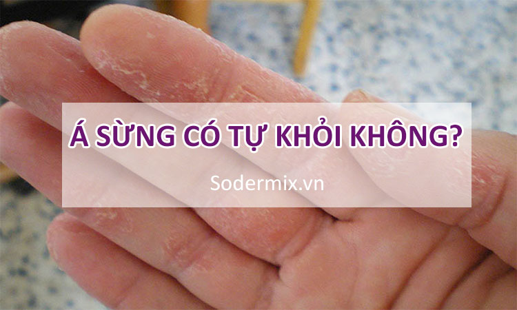 Á sừng có tự khỏi không, bao lâu thì khỏi?