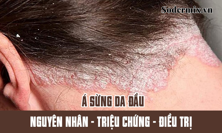 Á sừng da đầu: nguyên nhân - triệu chứng - cách điều trị