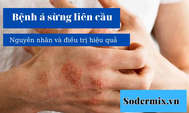 Bệnh á sừng liên cầu: nguyên nhân và cách điều trị hiệu quả!