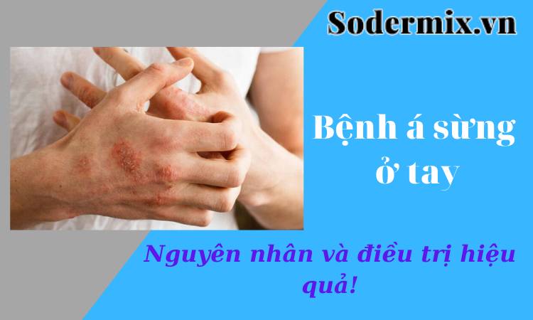 Hiểu hơn bệnh á sừng ở tay sau vài phút!