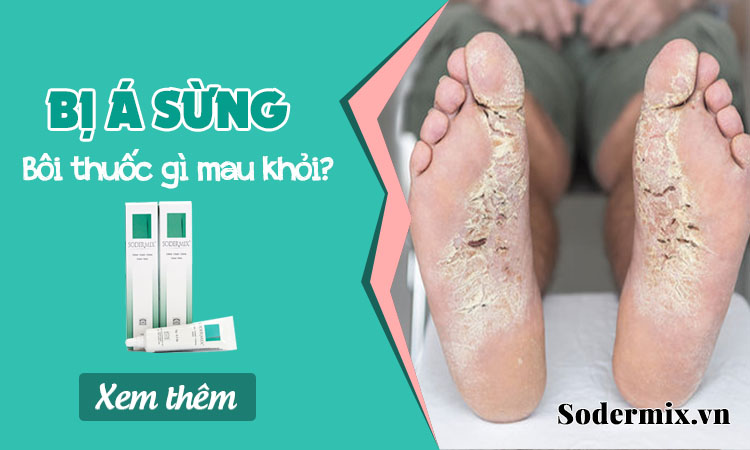 Bị á sừng bôi thuốc gì? - Hết đau rát, bạt sừng, tiêu ngứa