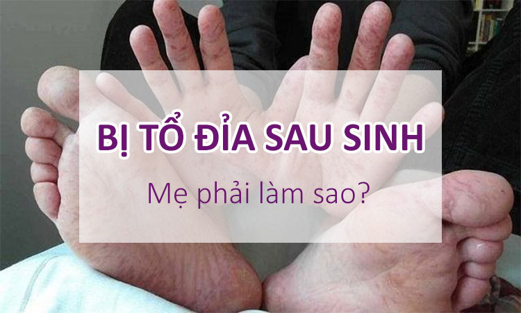 Bị tổ đỉa sau sinh - lời khuyên của chuyên gia!