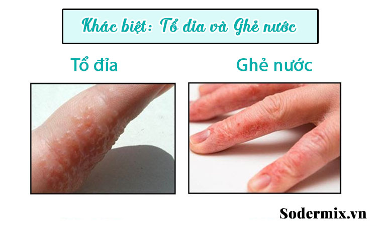 Tổ đỉa và ghẻ nước là 2 bệnh khác biệt 1