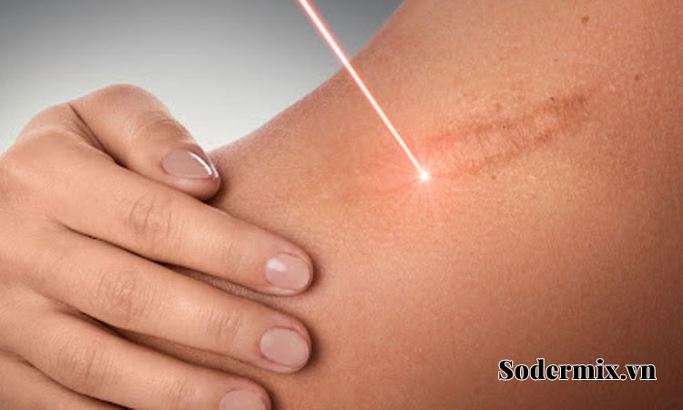 Trị liệu ánh sáng Laser 1