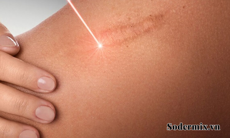 Sử dụng Laser trị sẹo lồi 1