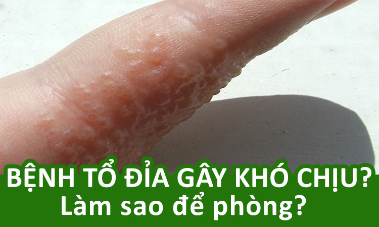 Cách phòng chống bệnh tổ đỉa hiệu quả không lo tái phát!