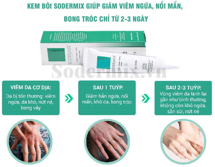 Kem bôi Sodermix - giải pháp vượt trội cho người bệnh á sừng 1