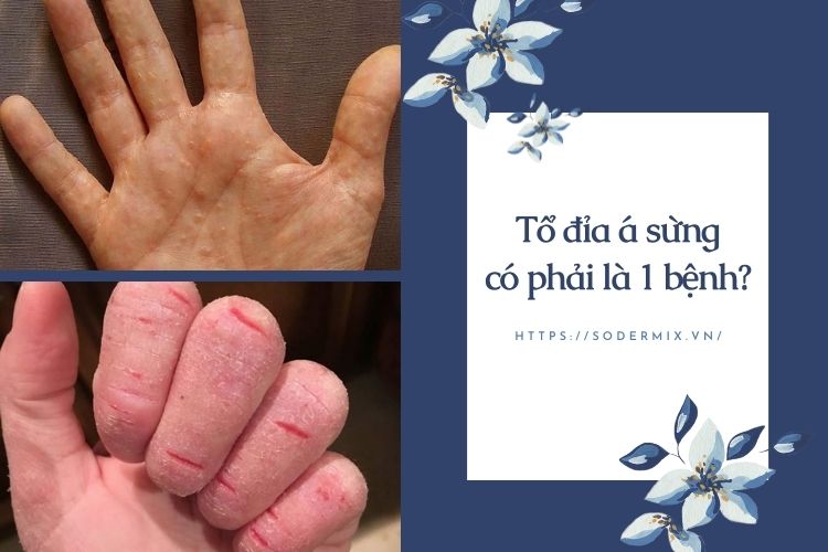 Tổ đỉa á sừng có phải là 1 bệnh? 1