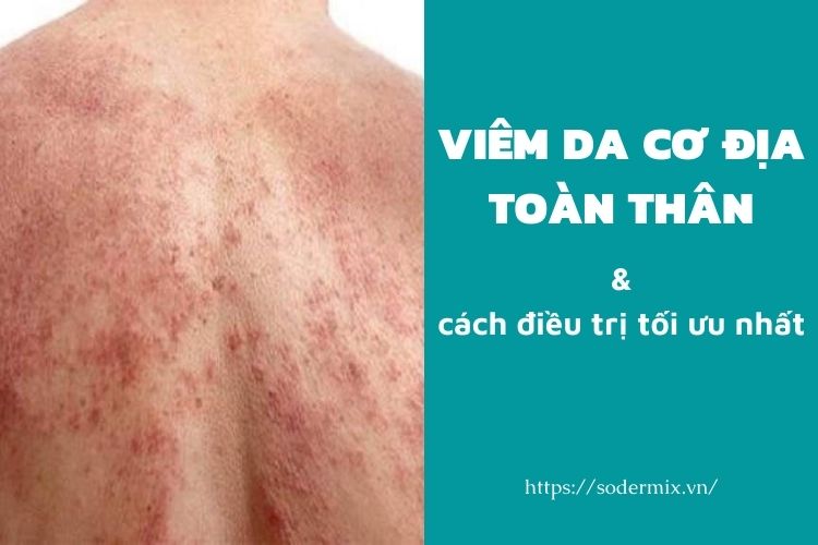 Viêm da cơ địa toàn thân và cách điều trị tối ưu nhất