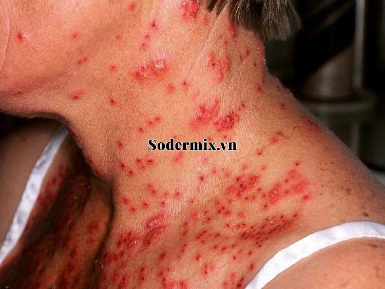 Eczema có nguy hiểm không? 1