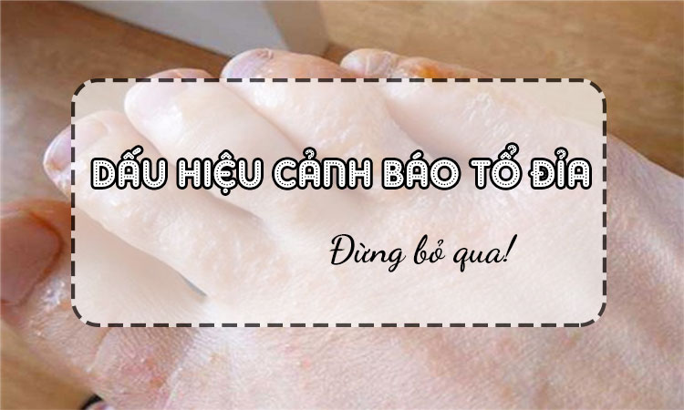 Dấu hiệu cảnh báo tổ đỉa  - Tuyệt đối đừng bỏ qua!