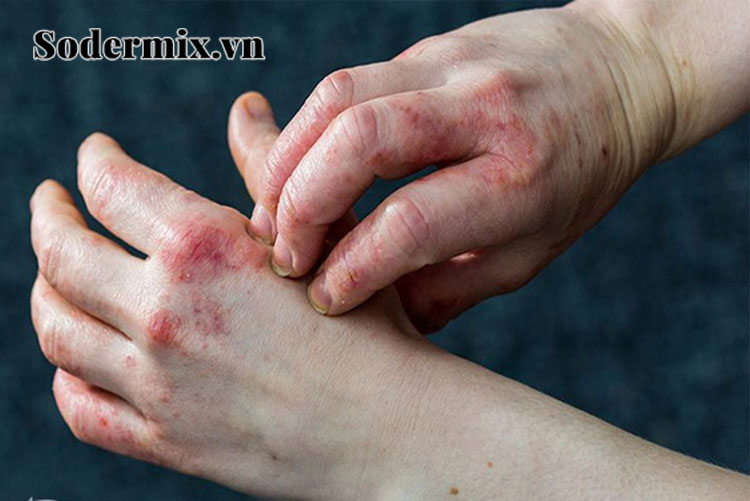 Eczema có trị dứt điểm được không? 1