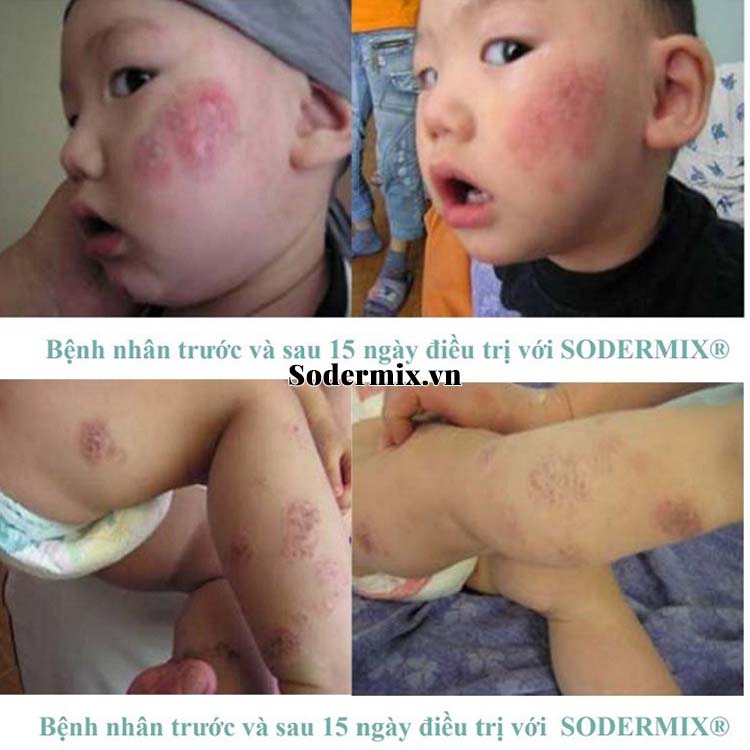 Sodermix - Bí quyết trị eczema hiệu quả từ tự nhiên 2
