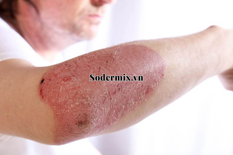 Eczema là bệnh gì? 1