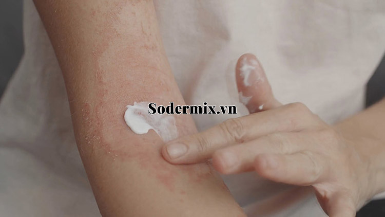 Điều trị tại chỗ eczema giai đoạn bán cấp 1