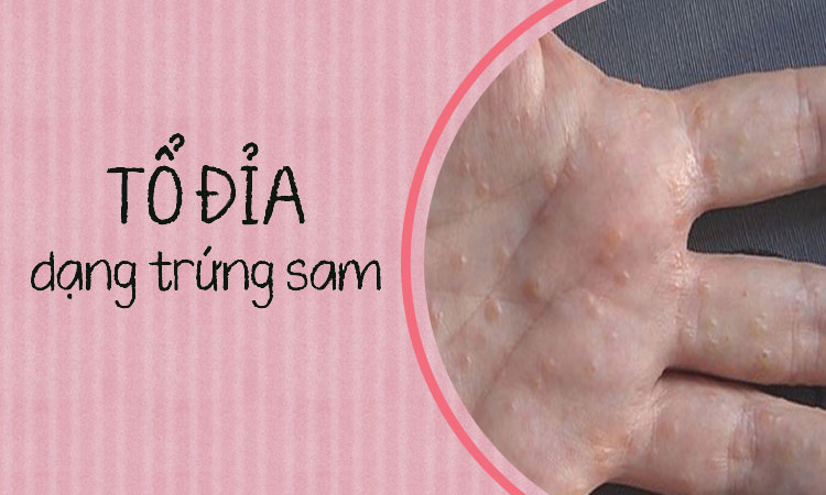 Tổ đỉa chàm dạng trứng sam? Phải làm sao?