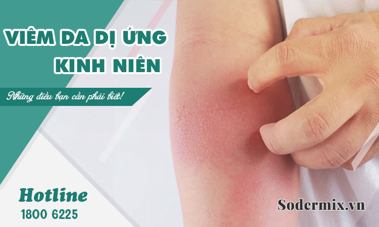 Viêm da dị ứng kinh niên: Điều bác sĩ muốn bạn biết!