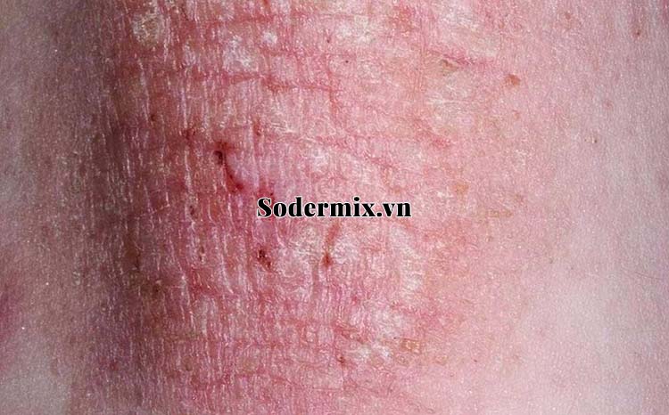 Bài thuốc trị eczema mãn tính thể tỳ hư thấp trệ 1