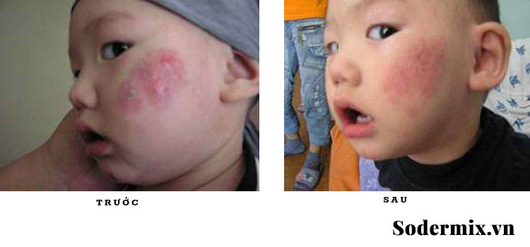 Sodermix trị eczema an toàn nhờ thành phần tự nhiên 3
