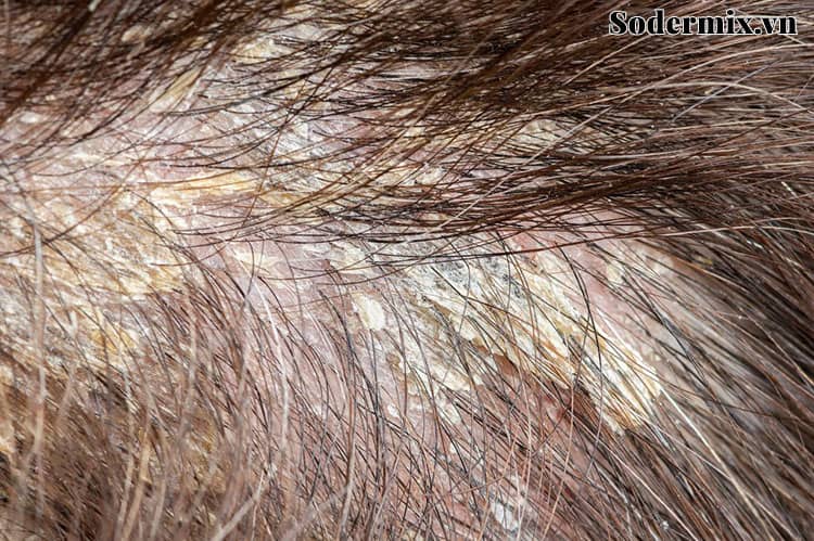 Viêm da đầu tiết bã là gì? 1