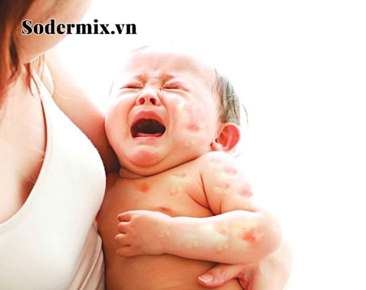 Viêm da dị ứng gây ảnh hưởng gì với trẻ sơ sinh? 1