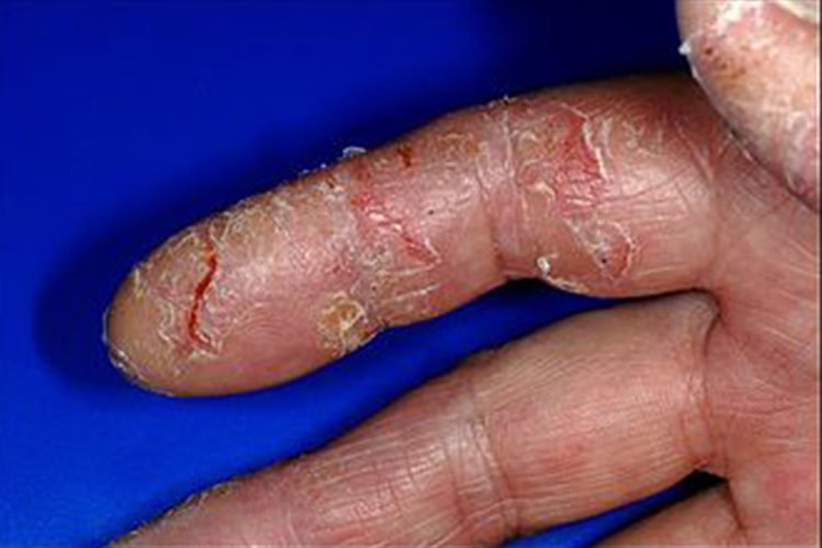 “Đau thì còn cố mà chịu được, chứ vừa đau vừa ngứa thì ai mà chịu nổi” 2